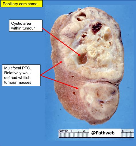 fibroadenomuri multiple care adăpostesc carcinom